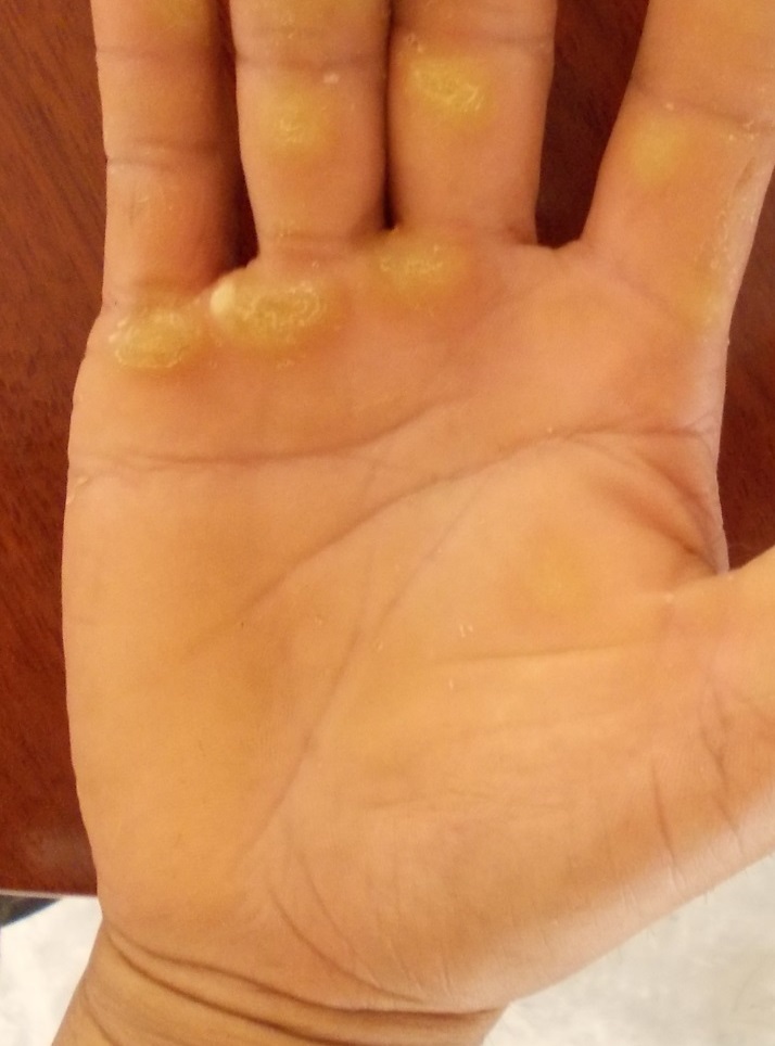 มือด้าน