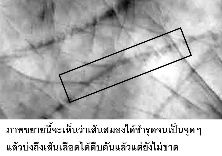 เป็นอัมพฤกษ์แล้วหาย